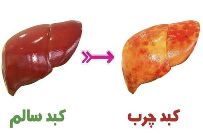 کبدچرب