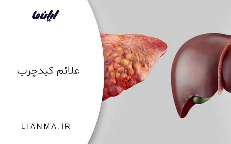 علائم کبد چرب